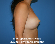 plastic-surgery-breast-augmentation